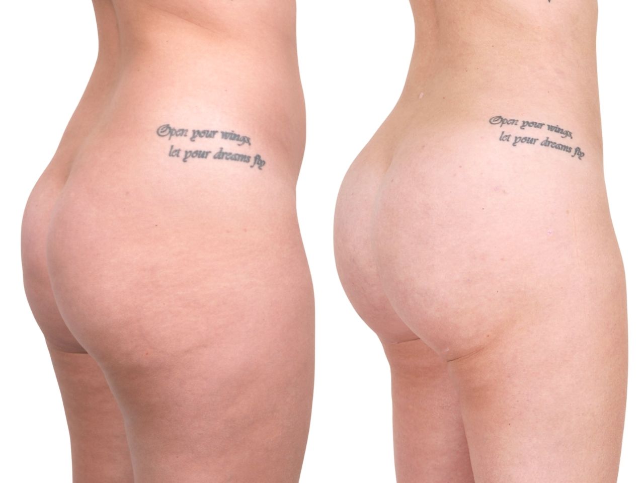 Before and after BBL, right view of a female patient treated by Dr. Benjamin Eskenazi at Avabello Aesthetics in Miami Beach.