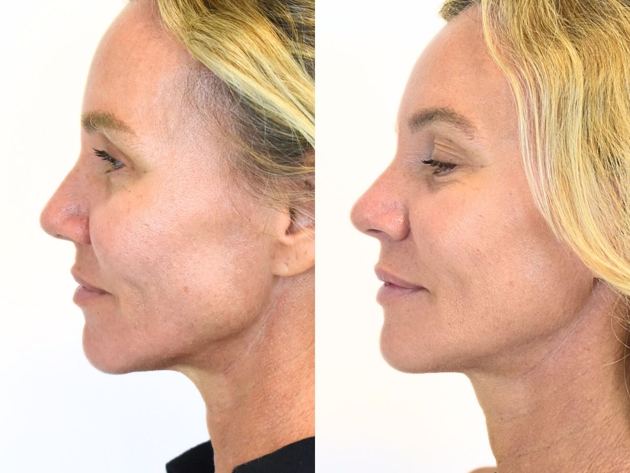 Before and after FaceTite treatment, left view of a female patient treated by Dr. Benjamin Eskenazi at Avabello Aesthetics in Miami Beach.