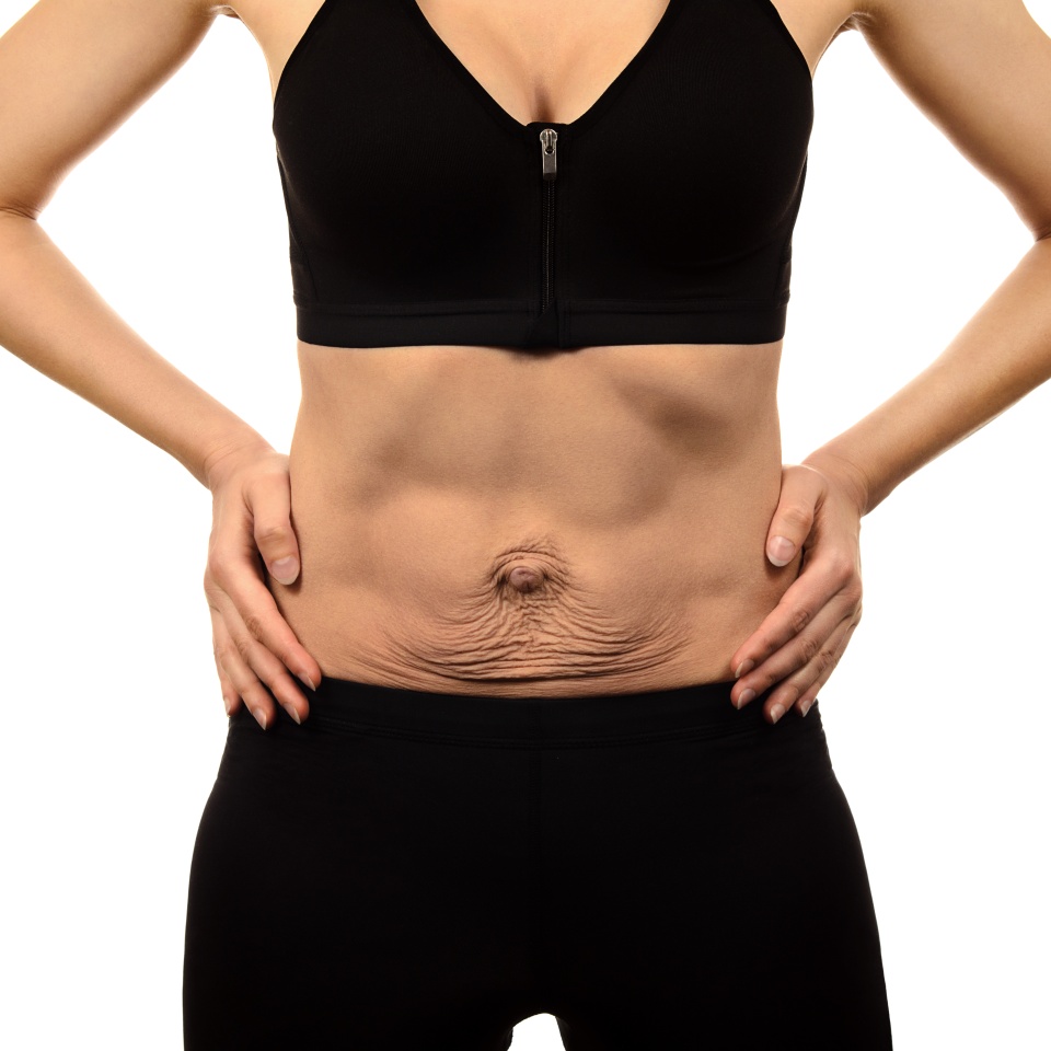Diastasis recti. Woman's abdomen divergence of the muscles of the abdomen after pregnancy and childbirth. Loose skin on belly.