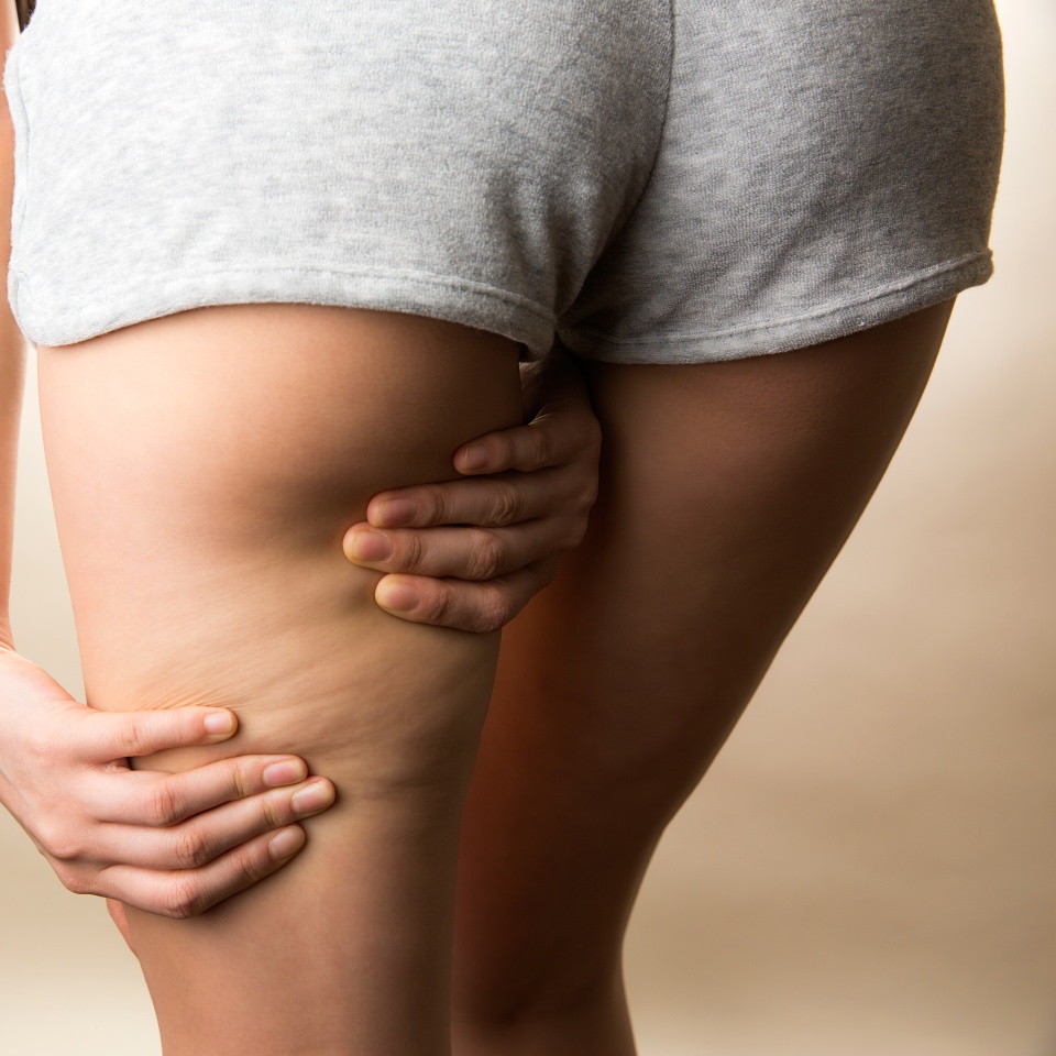 A woman who emphasizes thigh cellulite.