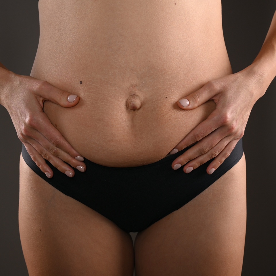 The young woman shows changes in her figure after childbirth, diastasis, flabby saggy belly. Concept of body care, weight loss