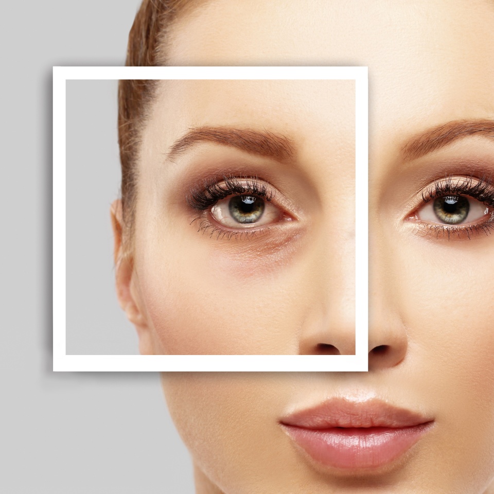 Blefaroplastia inferior. Concepto de cirugía plástica. 