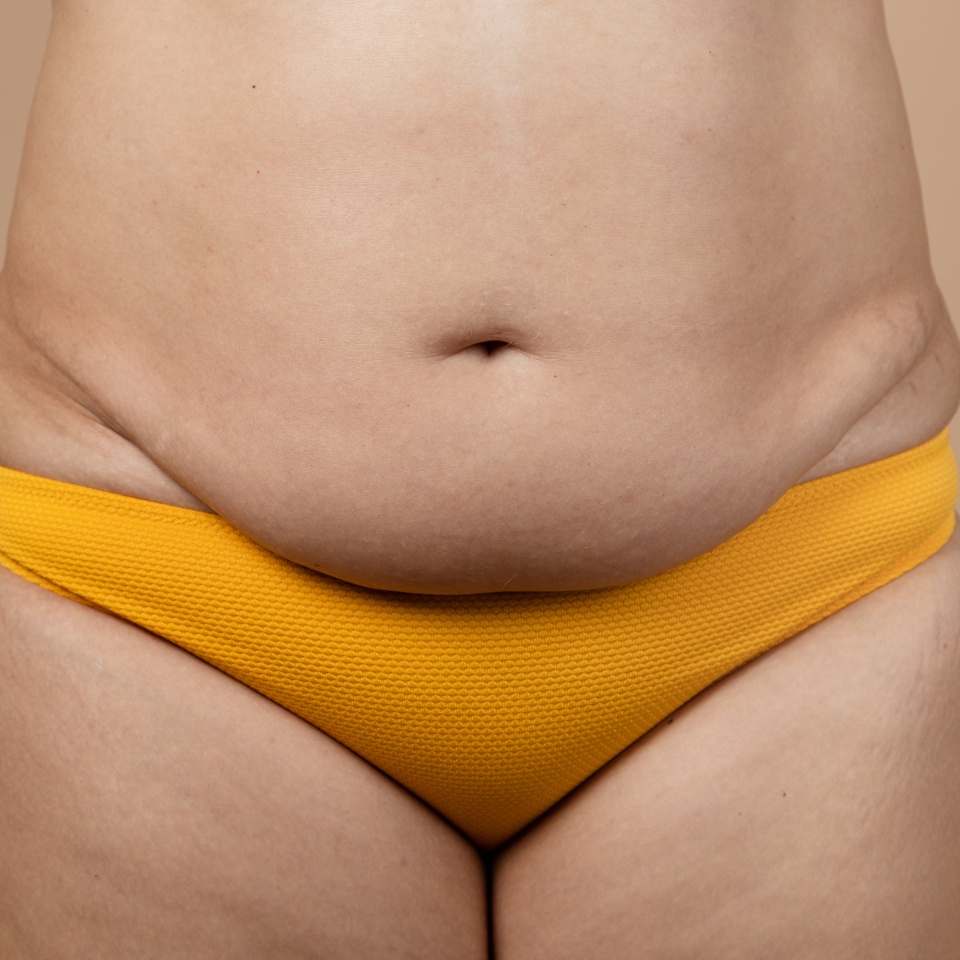 Cropped image of overweight fat pregnant woman sag stomach with obesity, excess fat in yellow pants. Fast weight loss. Stomach flabs. Dehydrated, flabby skin swelling, losing turgor collagen. Surgery