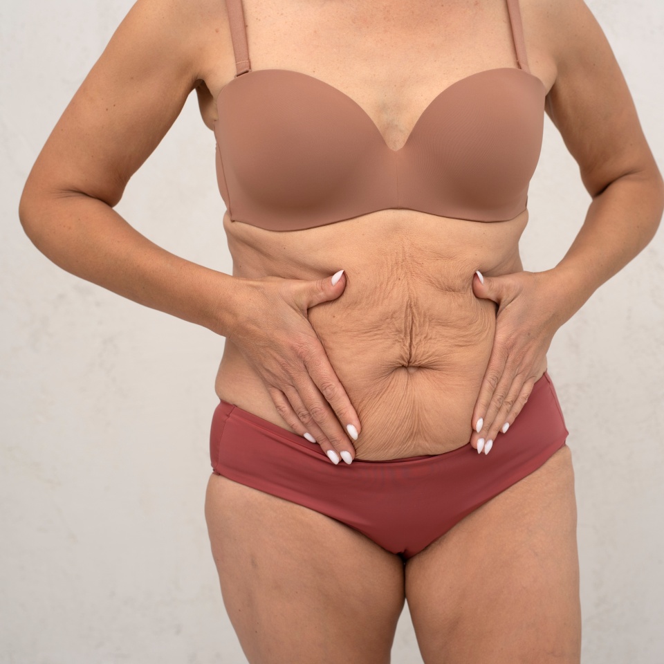 Close-up of a mature woman’s abdomen with loose, sagging skin after weight loss. Concept of body changes, aging, weight loss, cosmetic procedures, and self-acceptance.