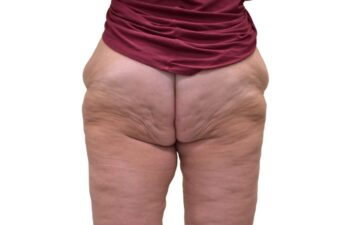 After Thighplasty, back view of a female patient treated by Dr. Benjamin Eskenazi at Avabello Aesthetics in Miami Beach.