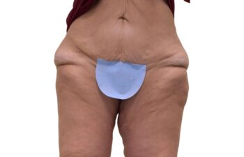 After Thighplasty, front view of a female patient treated by Dr. Benjamin Eskenazi at Avabello Aesthetics in Miami Beach.