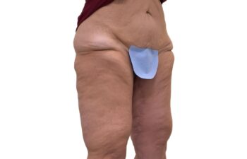 After Thighplasty, right oblique view of a female patient treated by Dr. Benjamin Eskenazi at Avabello Aesthetics in Miami Beach.