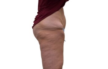 After Thighplasty, right view of a female patient treated by Dr. Benjamin Eskenazi at Avabello Aesthetics in Miami Beach.