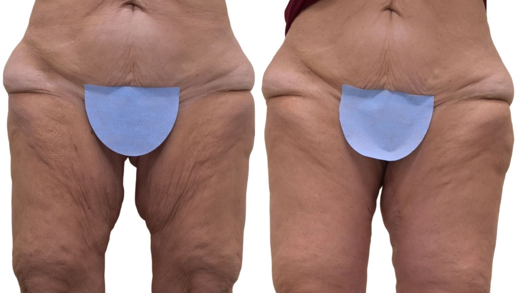 Before and after Thighplasty, front view of a female patient treated by Dr. Benjamin Eskenazi at Avabello Aesthetics in Miami Beach.