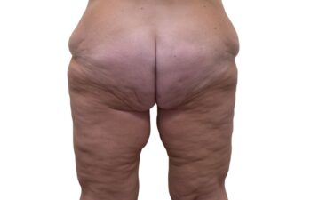 Before Thighplasty, back view of a female patient treated by Dr. Benjamin Eskenazi at Avabello Aesthetics in Miami Beach.
