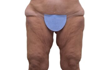 Before Thighplasty, front view of a female patient treated by Dr. Benjamin Eskenazi at Avabello Aesthetics in Miami Beach.