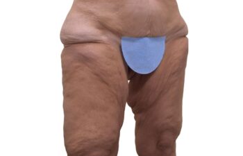 Before Thighplasty, right oblique view of a female patient treated by Dr. Benjamin Eskenazi at Avabello Aesthetics in Miami Beach.