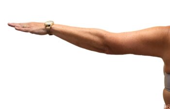 After arm lift, left back view of a female patient treated by Dr. Benjamin Eskenazi at Avabello Aesthetics.