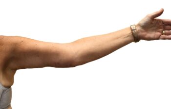 After arm lift, left front view of a female patient treated by Dr. Benjamin Eskenazi at Avabello Aesthetics.