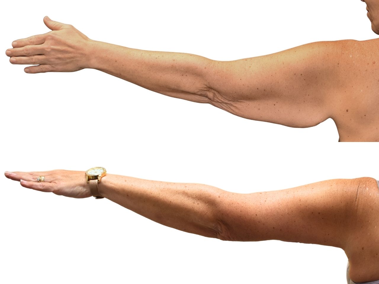 Before and after arm lift, left view of a female patient treated by Dr. Benjamin Eskenazi at Avabello Aesthetics.