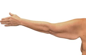 Before arm lift, left back view of a female patient treated by Dr. Benjamin Eskenazi at Avabello Aesthetics.