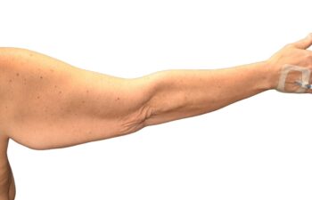 Before arm lift, right back view of a female patient treated by Dr. Benjamin Eskenazi at Avabello Aesthetics.