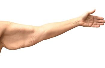 Before arm lift, left front view of a female patient treated by Dr. Benjamin Eskenazi at Avabello Aesthetics.