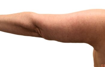 After arm lift, left back view of a female patient treated by Dr. Benjamin Eskenazi at Avabello Aesthetics.