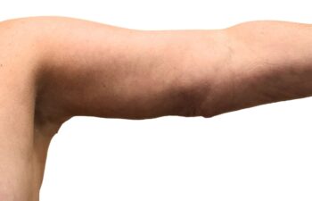 After arm lift, left view of a female patient treated by Dr. Benjamin Eskenazi at Avabello Aesthetics.