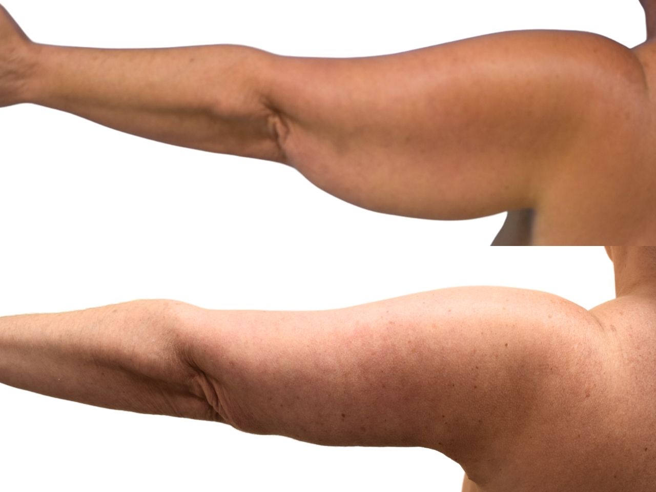 Before and after arm lift, left back view of a female patient treated by Dr. Benjamin Eskenazi at Avabello Aesthetics.