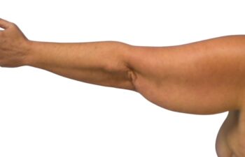 After arm lift, left back view of a female patient treated by Dr. Benjamin Eskenazi at Avabello Aesthetics.