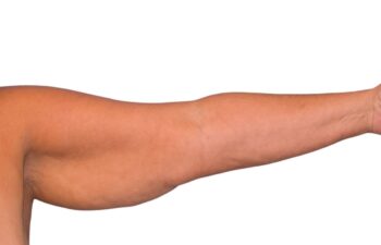 After arm lift, left view of a female patient treated by Dr. Benjamin Eskenazi at Avabello Aesthetics.