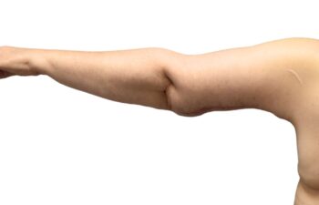After arm lift, left back view of a female patient treated by Dr. Benjamin Eskenazi at Avabello Aesthetics.