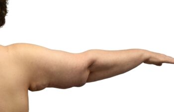 After arm lift, right back view of a female patient treated by Dr. Benjamin Eskenazi at Avabello Aesthetics.