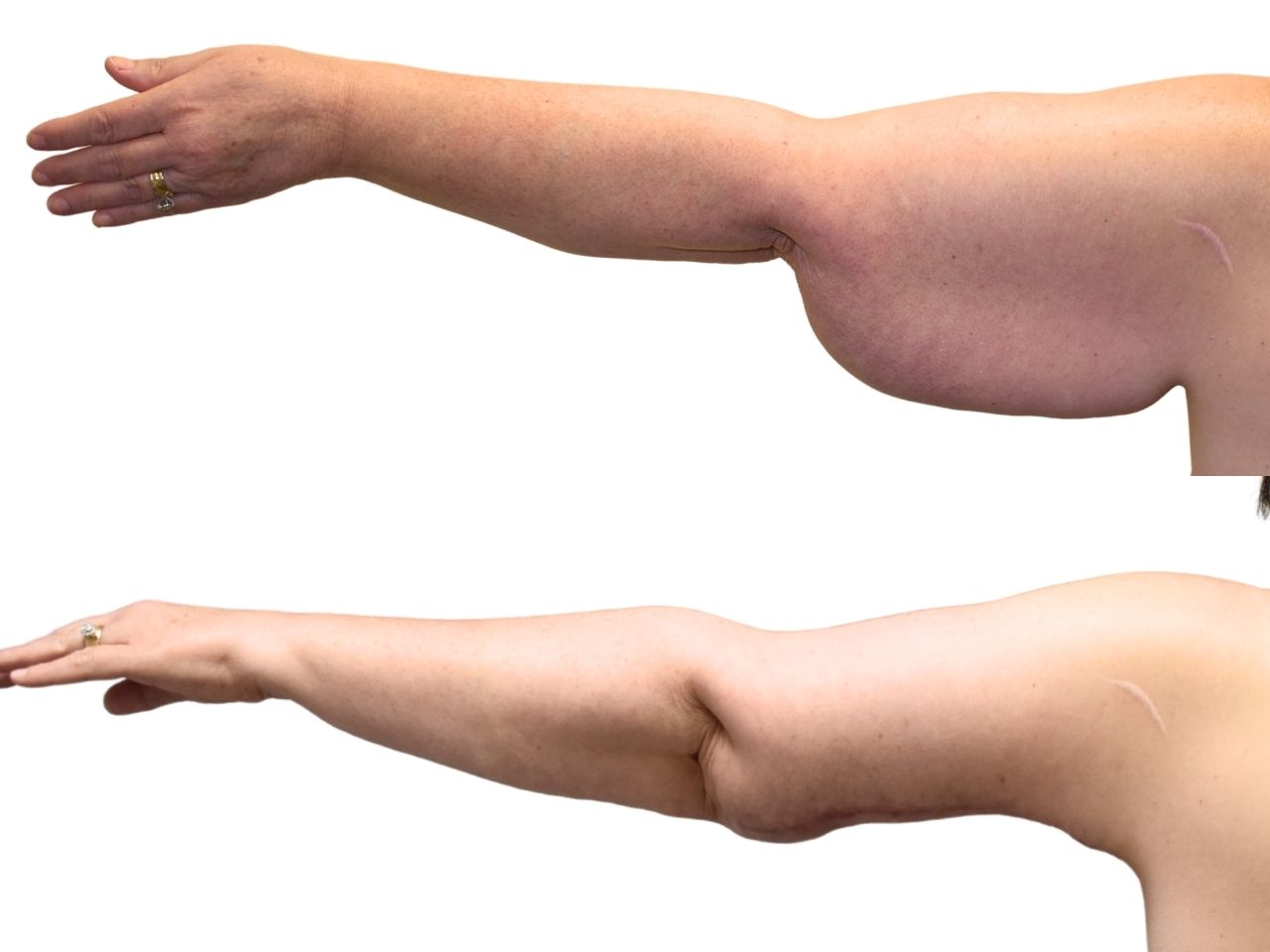 Before and after arm lift, left back view of a female patient treated by Dr. Benjamin Eskenazi at Avabello Aesthetics.