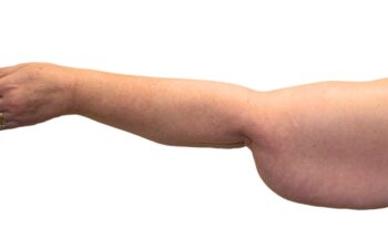 Before arm lift, left back view of a female patient treated by Dr. Benjamin Eskenazi at Avabello Aesthetics.