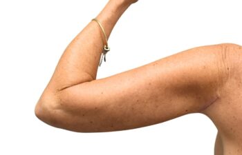 After arm lift, left back view of a female patient treated by Dr. Benjamin Eskenazi at Avabello Aesthetics.
