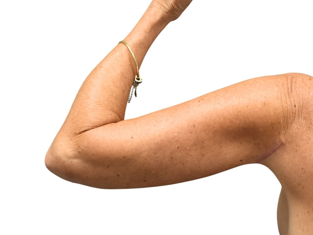 After arm lift, left back view of a female patient treated by Dr. Benjamin Eskenazi at Avabello Aesthetics.