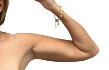 After arm lift, left view of a female patient treated by Dr. Benjamin Eskenazi at Avabello Aesthetics.