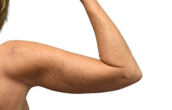 After arm lift, right back view of a female patient treated by Dr. Benjamin Eskenazi at Avabello Aesthetics.