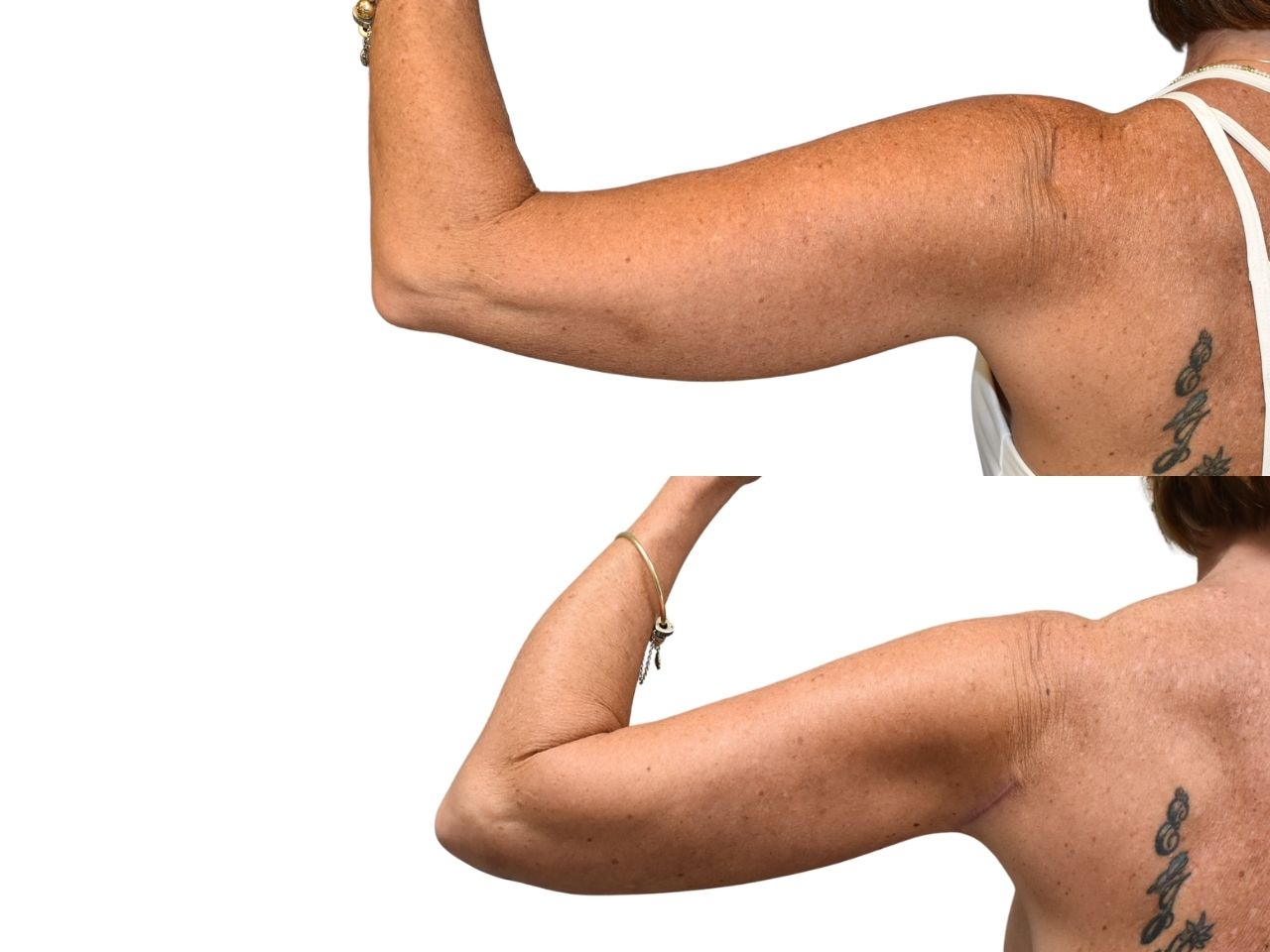Before and after arm lift, left back view of a female patient treated by Dr. Benjamin Eskenazi at Avabello Aesthetics.
