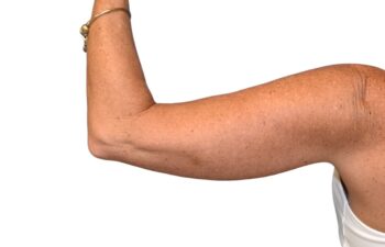 Before arm lift, left back view of a female patient treated by Dr. Benjamin Eskenazi at Avabello Aesthetics.