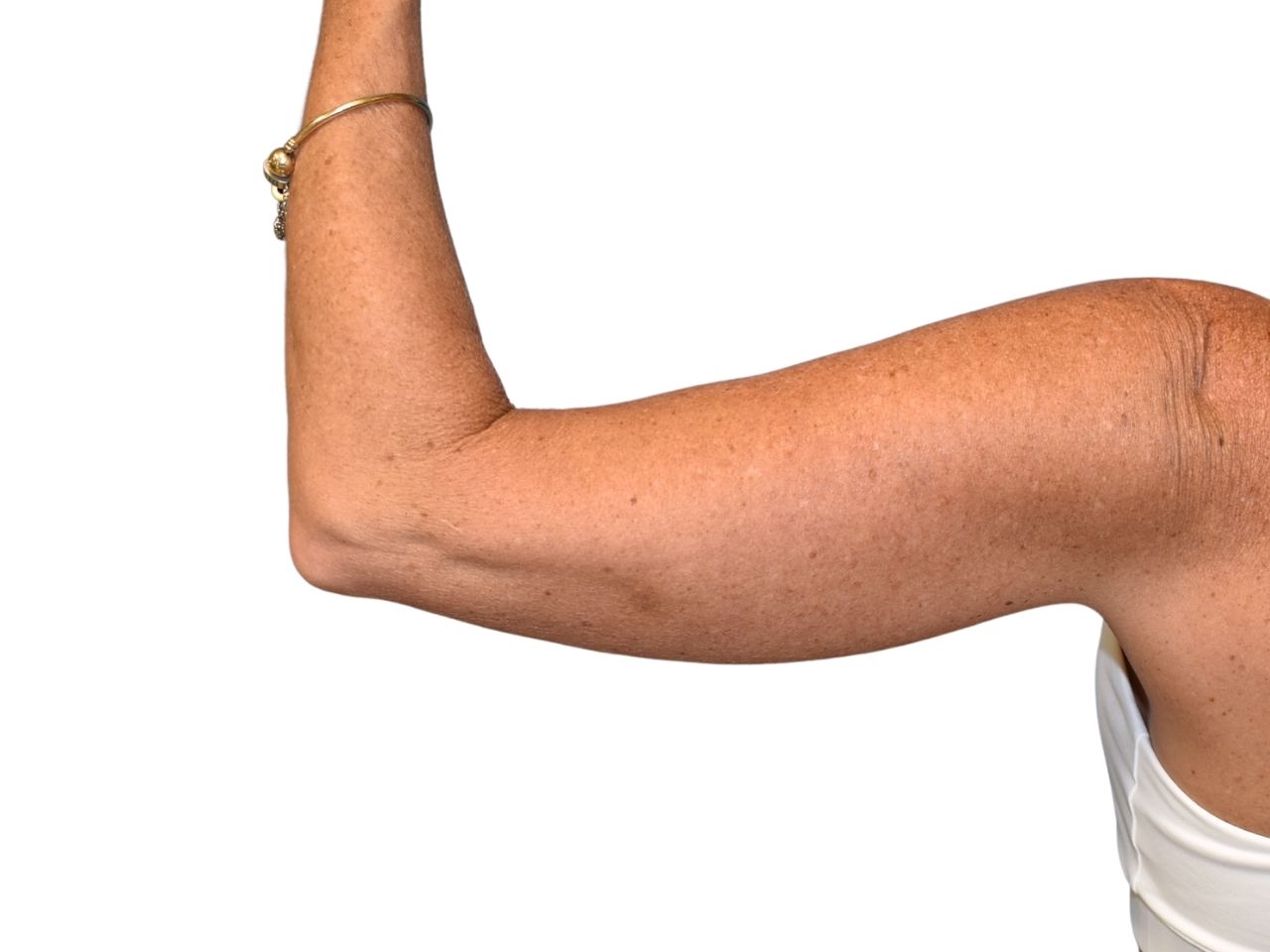 Before arm lift, left back view of a female patient treated by Dr. Benjamin Eskenazi at Avabello Aesthetics.