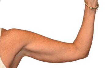 Before arm lift, left view of a female patient treated by Dr. Benjamin Eskenazi at Avabello Aesthetics.