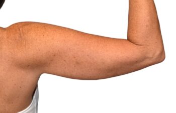 Before arm lift, right back view of a female patient treated by Dr. Benjamin Eskenazi at Avabello Aesthetics.