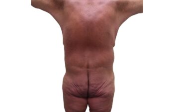 After body contouring following weight loss, back view of a male patient treated by Dr. Benjamin Eskenazi at Avabello Aesthetics in Miami Beach.