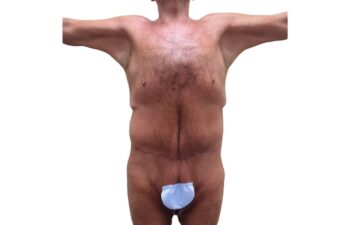 After body contouring following weight loss, front view of a male patient treated by Dr. Benjamin Eskenazi at Avabello Aesthetics in Miami Beach.