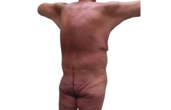 After body contouring following weight loss, back right oblique view of a male patient treated by Dr. Benjamin Eskenazi at Avabello Aesthetics in Miami Beach.