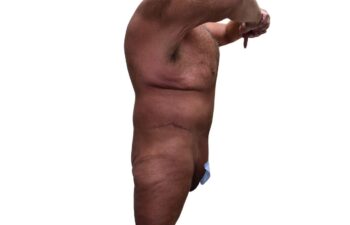 After body contouring following weight loss, right view of a male patient treated by Dr. Benjamin Eskenazi at Avabello Aesthetics in Miami Beach.