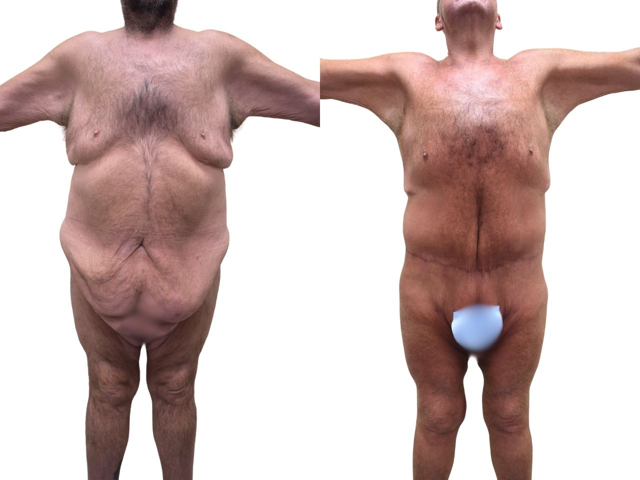 Before and after body contouring following weight loss, front view of a male patient treated by Dr. Benjamin Eskenazi at Avabello Aesthetics in Miami Beach.