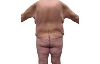 Before body contouring following weight loss, back oblique view of a male patient treated by Dr. Benjamin Eskenazi at Avabello Aesthetics in Miami Beach.