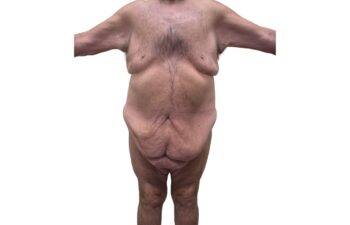 Before body contouring following weight loss, front view of a male patient treated by Dr. Benjamin Eskenazi at Avabello Aesthetics in Miami Beach.