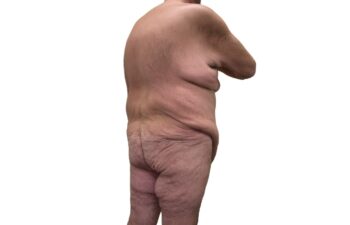 Before body contouring following weight loss, back right oblique view of a male patient treated by Dr. Benjamin Eskenazi at Avabello Aesthetics in Miami Beach.