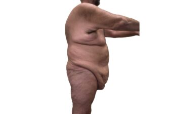 Before body contouring following weight loss, right view of a male patient treated by Dr. Benjamin Eskenazi at Avabello Aesthetics in Miami Beach.