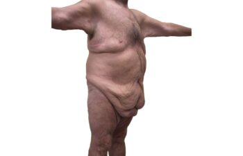 Before body contouring following weight loss, right oblique view of a male patient treated by Dr. Benjamin Eskenazi at Avabello Aesthetics in Miami Beach.